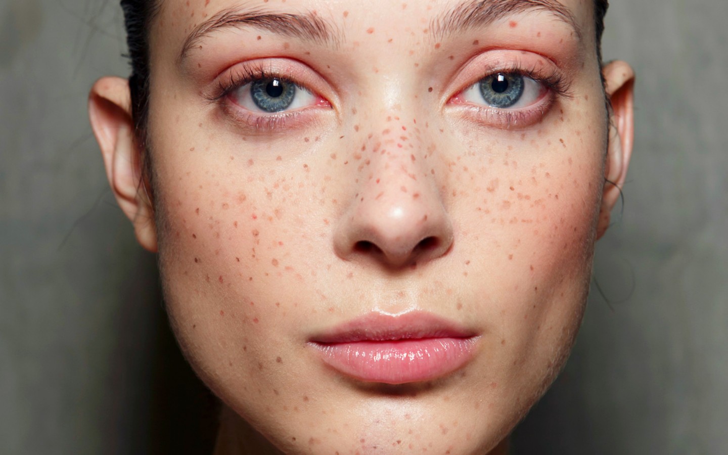What Are Freckles? And How To Tell Them Apart From Melasma - Strut Blog